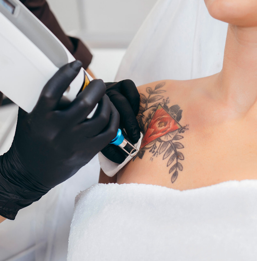 Tattoo Laser Removal